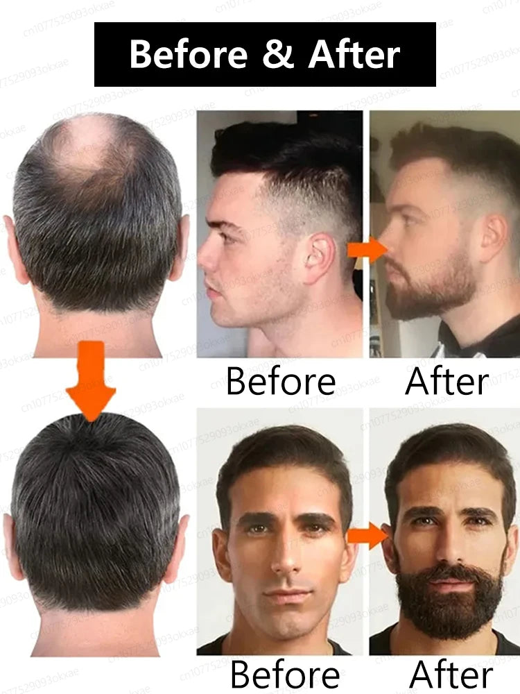 The most effective beard growth essence in 2025, grow a thick beard in 7 days. Chest hair, leg hair, beard and hair growth Eagle Beacon