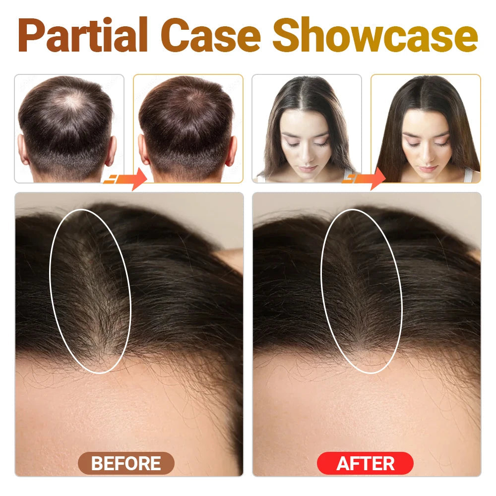 Clinical Grade LLLT Hair Regrowth Device Anti Hair Loss Machine For Scalp Health Thinning Hair Stress Anxiety Management Eagle Beacon