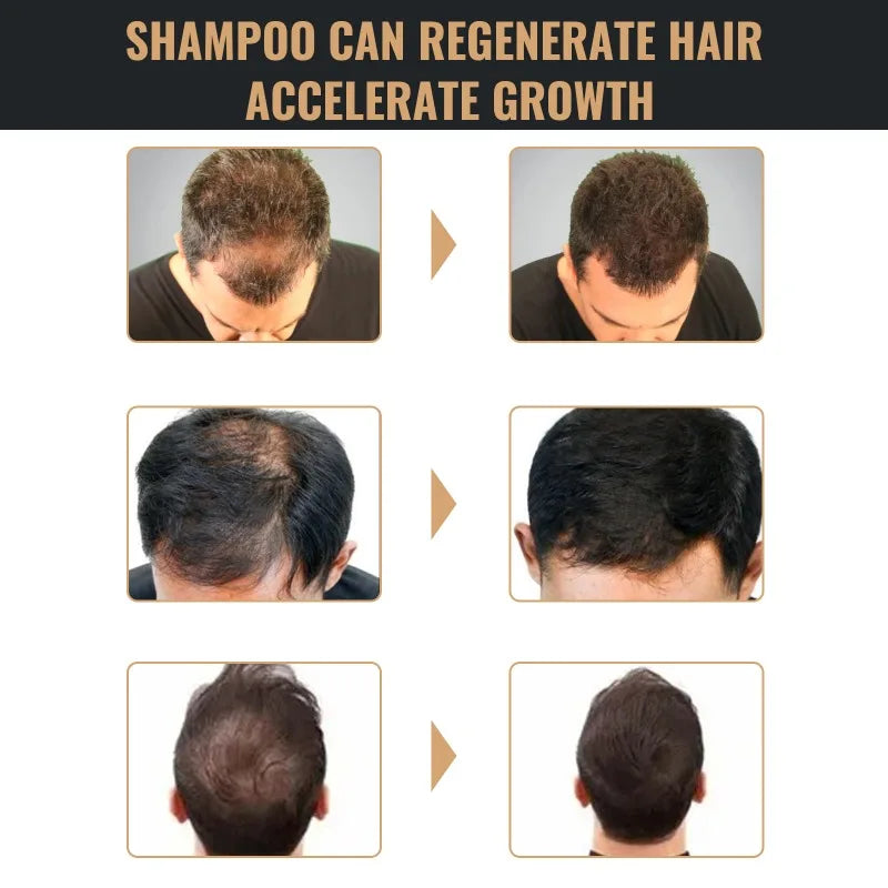 Hair Loss Treatment Shampoo Promote Growth Strengthen Hair Roots Scalp Repair Anti Thinning Moisturizing Thickening Hair Care Eagle Beacon
