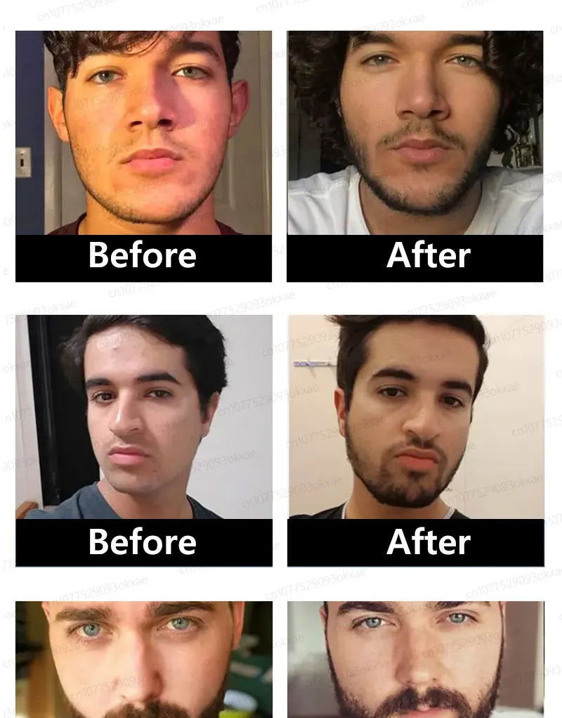 The most effective beard growth essence in 2025, grow a thick beard in 7 days. Chest hair, leg hair, beard and hair growth Eagle Beacon