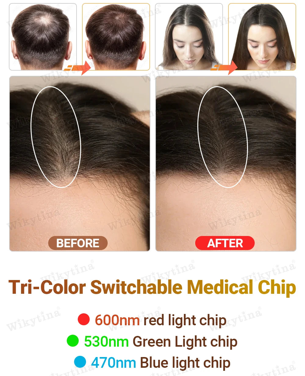 Clinical Grade LLLT Hair Regrowth Device Anti Hair Loss Machine For Scalp Health Thinning Hair Stress Anxiety Management Eagle Beacon